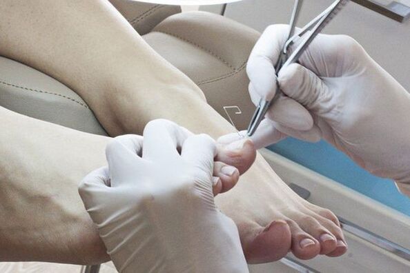 Mantardan etkilenen tırnakların mekanik olarak çıkarılması